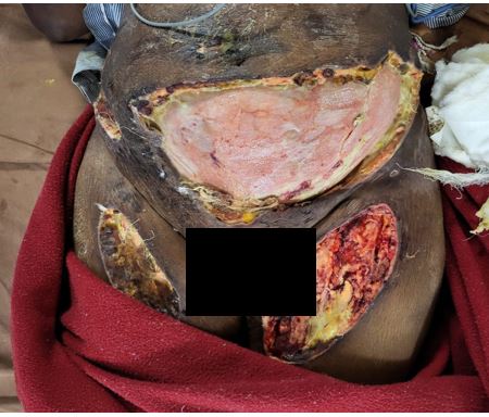 Rare Case of Post-Infectitous Hemophagocytic Lymphohistiocytosis Presenting as Panniculitis & Multi-...