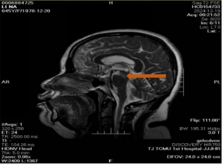 Effectiveness of Acupuncture in Treating Oculomotor Nerve Palsy and Limb Weakness in a Weber Syndrom...