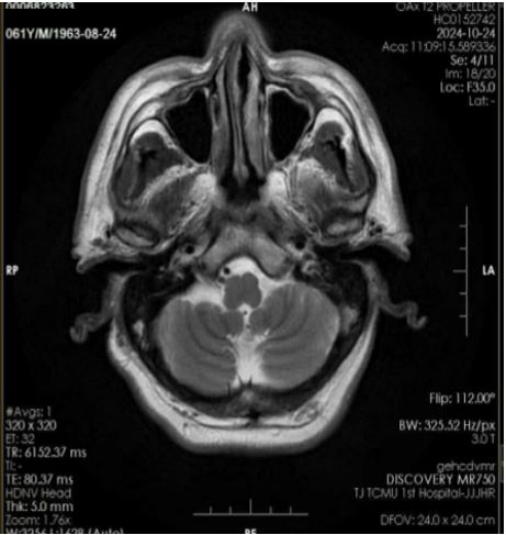 Acupuncture as an Integrative Therapy for Wallenberg Syndrome: A Case Report on Neurological Recover...